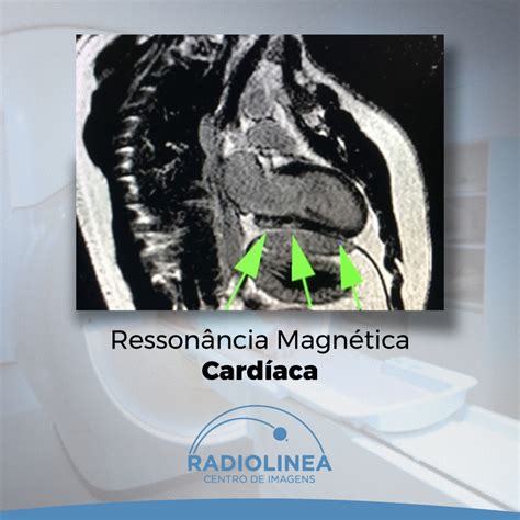 Ressonância Magnética Cardíaca Radiolinea Centro De Imagens