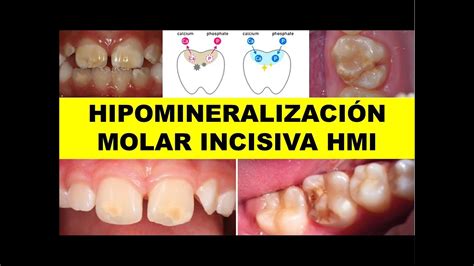 HIPOMINERALIZACIÓN MOLAR INCISIVA PROTOCOLOS ACTUALIZADOS DE ABORDAJE