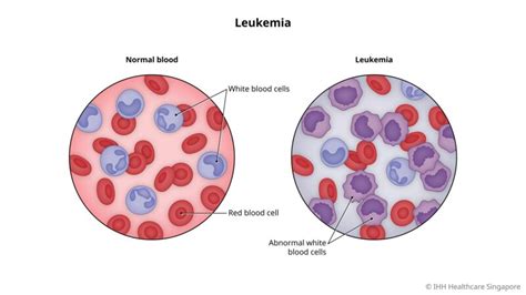 Acute Lymphoblastic Leukemia In Adults What Patients Should Know About