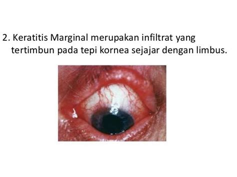 Keratitis Mata