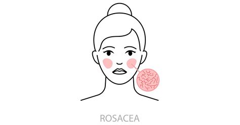 Rosacea Vs Lupus Understand The Difference In Symptoms