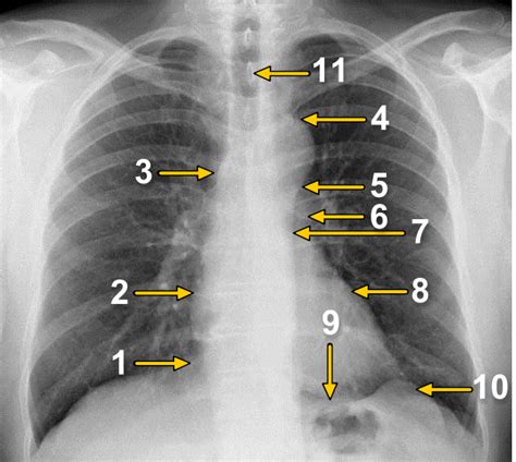 Radiographie Du Thorax Vue De Face