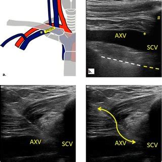 Ultrasound Guided Subclavian Cannulation Using In Plane Approach