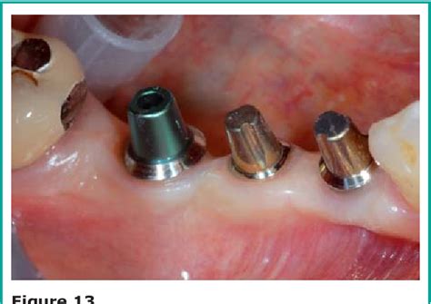 Figure From Piezoelectric Surgery In Mandibular Split Crest