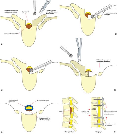 Surgical Procedures In Resection At An Anterior Site Of The Spinal Cord