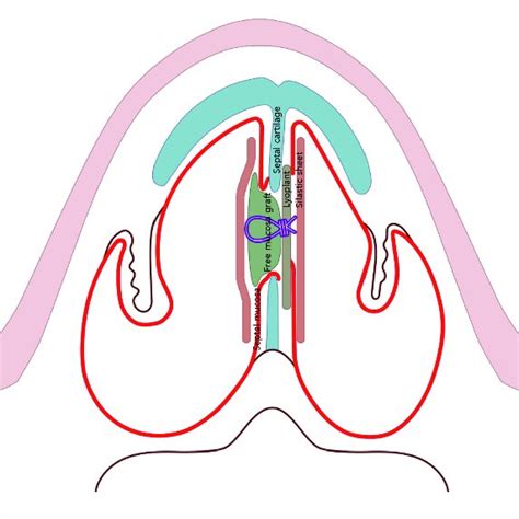 Illustration Of Endonasal Septal Perforation Repair With Free Mucosal