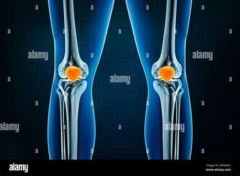 Patella oder kneecap Knochen Röntgen Front oder anteriore Ansicht