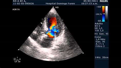 Insuficiencia Valvular Aortica Moderada A Severa Dr Pedro Guillermo