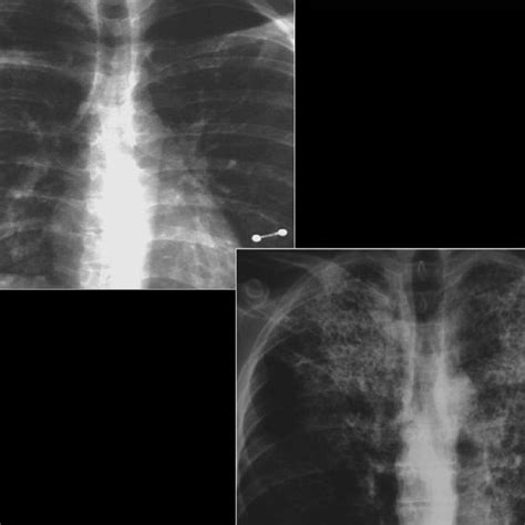 Pneumocystis Carinii Pneumonia Computed Tomography Ct In A Subacute Download Scientific