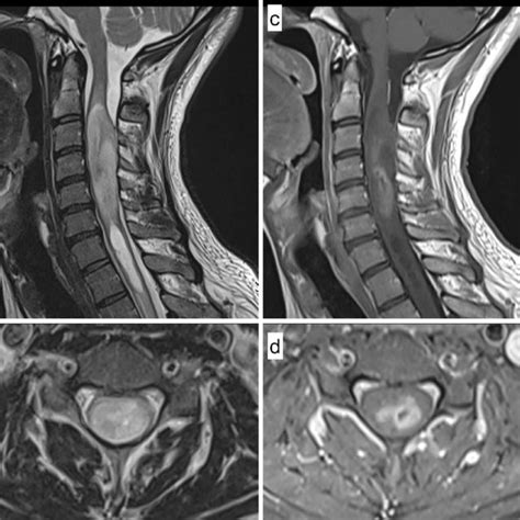 Radiological Findings Sagittal A And Axial B T Weighted Magnetic