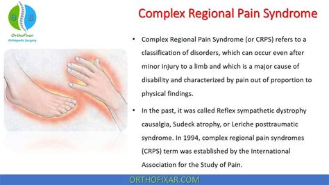 Complex Regional Pain Syndrome Orthofixar 2024