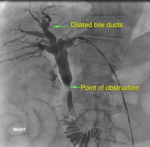 Blocked Bile Ducts – PTC – Sydney Medical Interventions