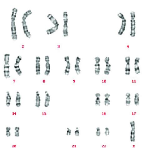 Cariotipo normal de un varón 46 XY Download Scientific Diagram