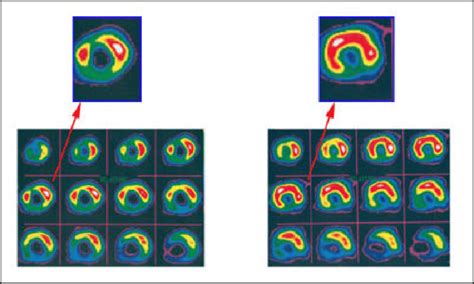 Stress Spect M Tc Sestamibi Scans In A Study Patient Having Received