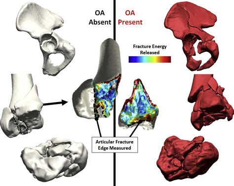 Fracture Severity Predicts Oa Risk Following Intra Articular Fractures