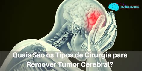 Sintomas De Tumor Cerebral Saiba Mais Dr Victor Barboza