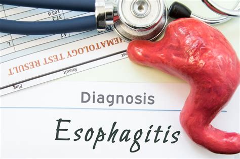 Understanding Esophagitis: Causes, Symptoms, and Treatments - Facty Health