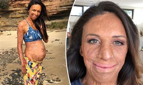 Turia Pitt Shows Off Her Growing Baby Bump During A Relaxing Day Out At