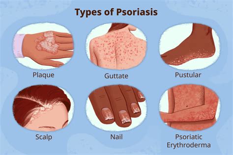 Psoriasis Symptoms Causes Triggers And Treatment Ensocure