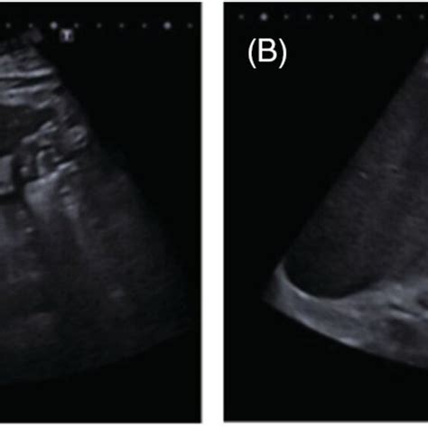 Liver ultrasound. (A) Cirrhotic liver with enlargement of the left lobe ...