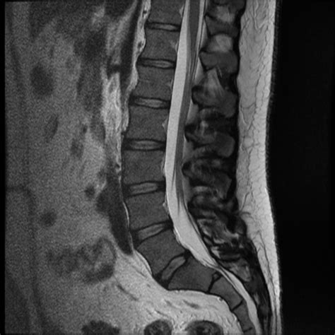 Normal lumbar spine MRI | Image | Radiopaedia.org