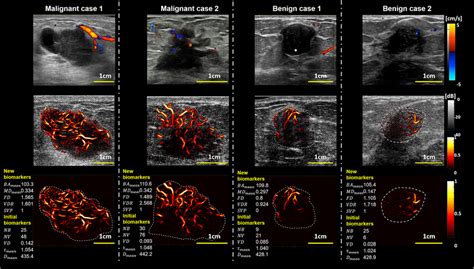 Representative Cases Of Tumor Vasculature Images Using Different