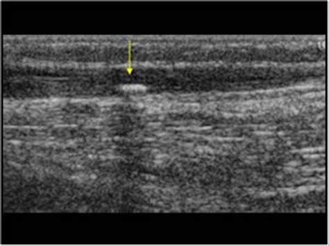 Calcification In The Veins