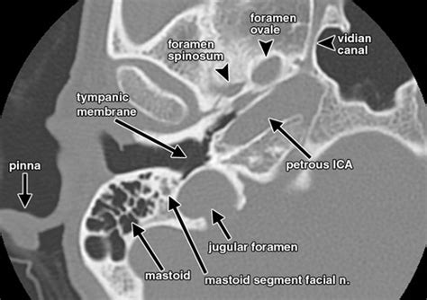 Interactive Web Based Learning Module On Ct Of The Temporal Bone