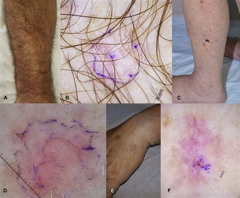 Representative Clinical And Dermoscopic Images Of Erythematous Scaly