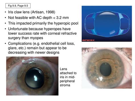 Ppt Chapter 9 Intraocular Lenses Powerpoint Presentation Free Download Id 1186643