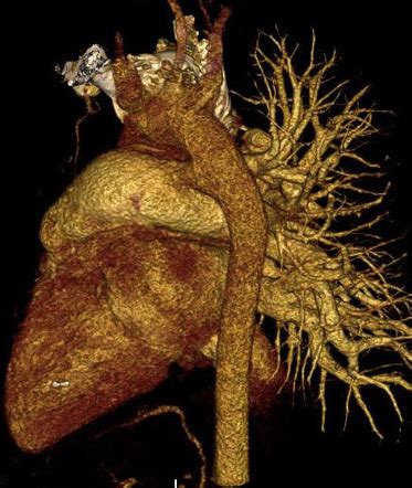 Unilateral Pulmonary Artery Atresia Image Radiopaedia Org