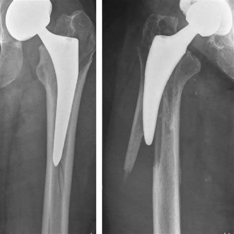 A Type B Periprosthetic Femoral Fracture Around Cemented Polished