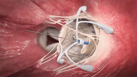 Minimally invasive mitral valve replacement surgery | Ghost Medical Images