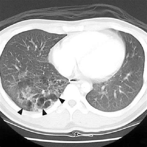 Computed Tomography Showed Multiple Cystic Lesions Of Variable Size