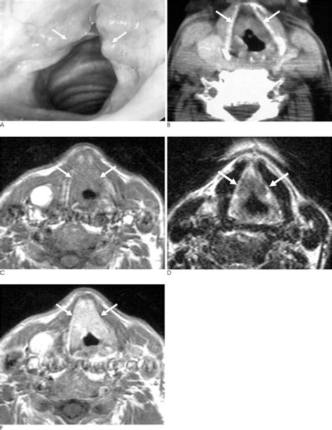 Laryngeal Amyloidosis Mimicking Glottic Cancer A Case Report