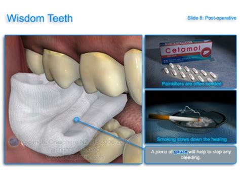 How To Extract Wisdom Tooth At Home