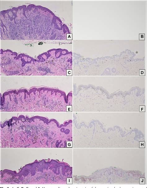 Figure 1 From Rapid Regression Of Multiple Melanocytic Nevi In An