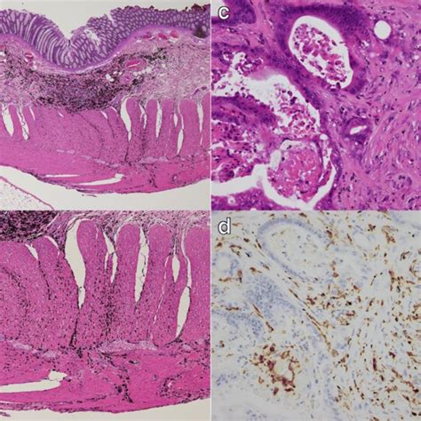 Sigmoid Colonoscopy Findings Circumferential Ulcerated Tumor Of The