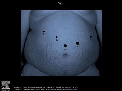 Robotic Sleeve Gastrectomy After Liver Transplantation Ppt Download