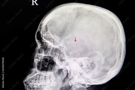 Xray Image Of A Patient With Linear Fracture Skull From Traumatic