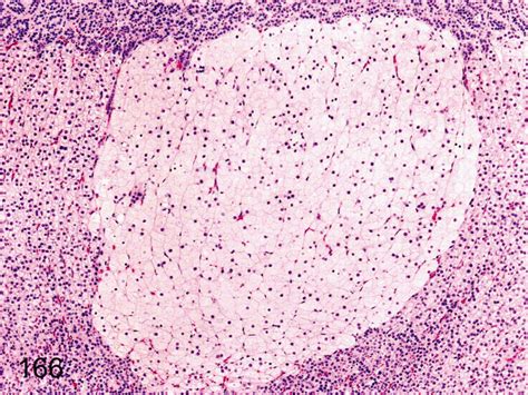 Adrenal Nodular Hyperplasia Of Cortical Cells Vacuolated A Focus Download Scientific