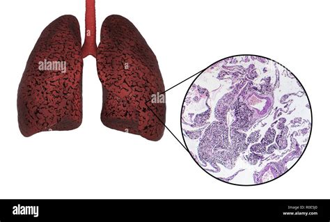 Lungs anatomy smoker hi-res stock photography and images - Alamy