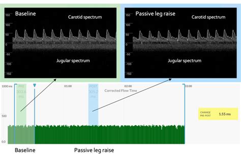 Continuous Venous Arterial Doppler Ultrasound During A Preload Challenge Scientific Article