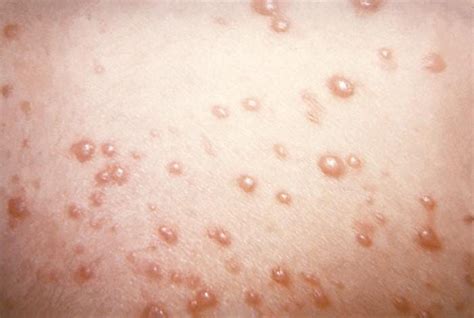 Cayman Islands Health Officials Report Chickenpox Outbreak In School System