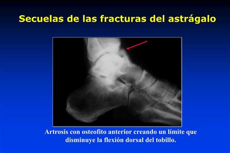 Ppt Fracturas Del Astrágalo Powerpoint Presentation Free Download