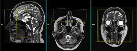 Mri Paranasal Sinuses Pns Planning And Protocols Indications For