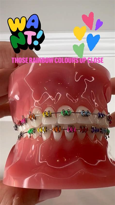 Those Rainbow Braces Colours Up Close 🌈 Braces Colors Rainbow Braces