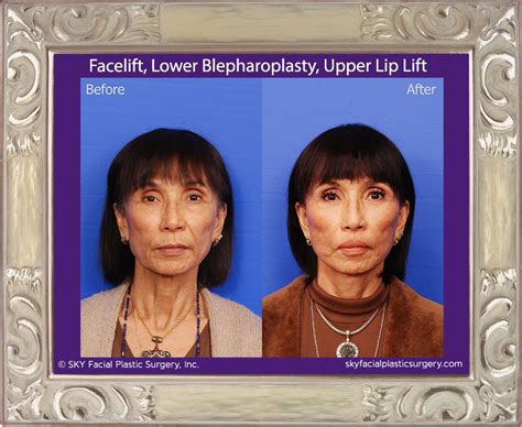 Facelift Twenty Two — Sky Facial Plastic Surgery