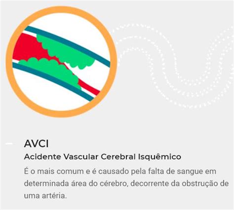 Principais Informa Es Sobre O Avc Sa De Em Tela