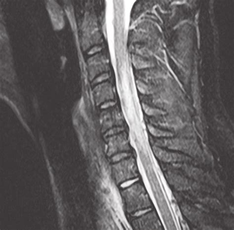 Fat Suppressed Magnetic Resonance Imaging Demonstrating Edema In The